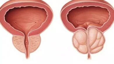 بدون دارو از بزرگ شدن پروستات پیشگیری کنید