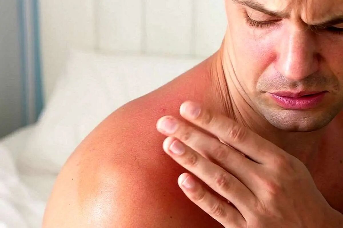 هشدار؛ مراقب سوختگی‌های پنهان آفتاب باشید