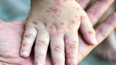 سر و کله ویروس سرخک از کجا پیدا شد؟