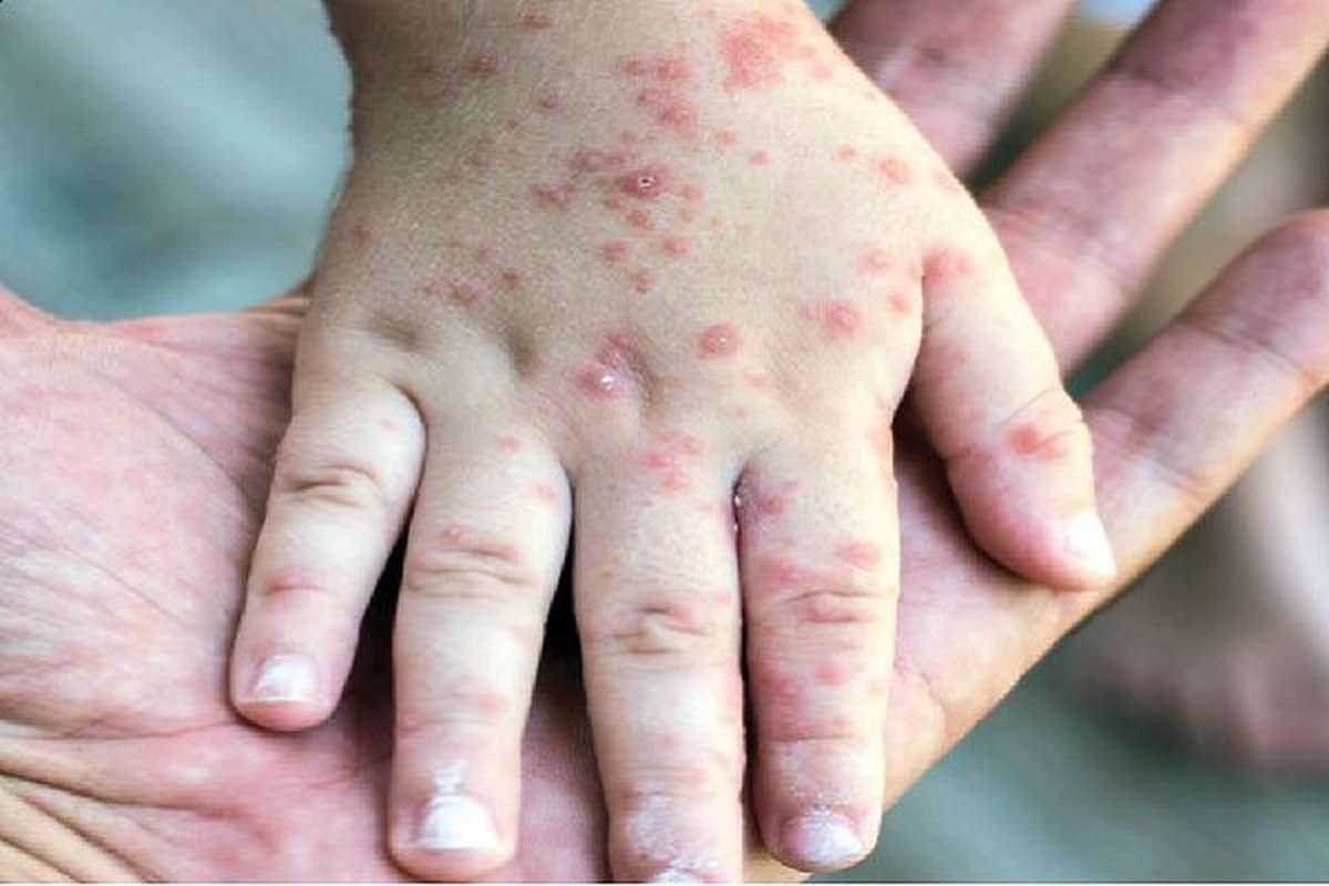 سر و کله ویروس سرخک از کجا پیدا شد؟