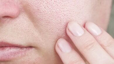 با منافذ باز پوست چه کنیم؟/ این منافذ به طور قطعی درمان می‌شوند؟