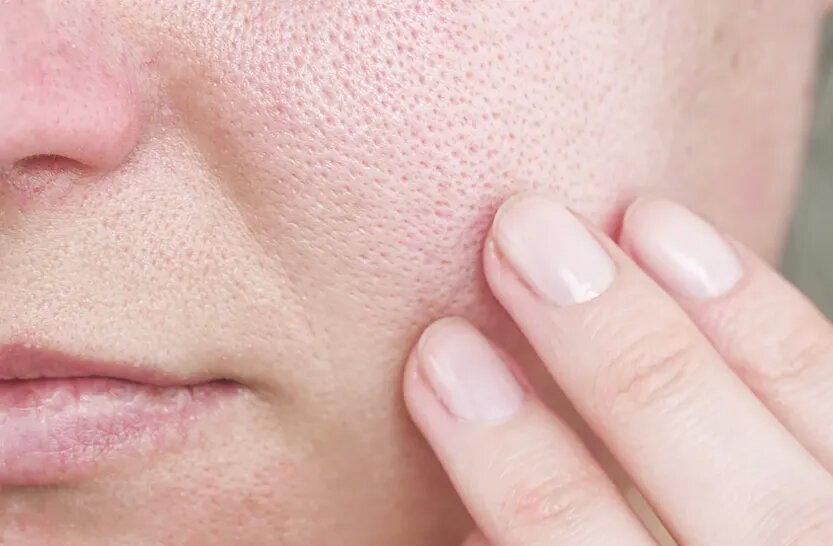 با منافذ باز پوست چه کنیم؟/ این منافذ به طور قطعی درمان میشوند؟