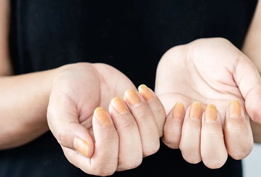 رنگ زرد ناخن نشانه چیست؟