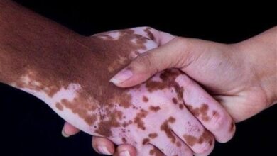 روشی برای کاهش لک‌های پوستی در ایران