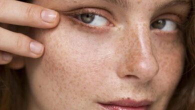 آشنایی با انواع لک‌های پوستی